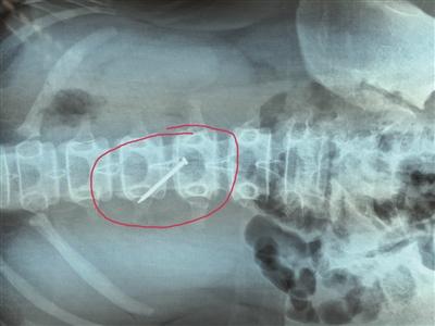 一起悬案,让人触目惊心!长约4厘米的铁钉被取出时,已刺穿13岁女生的胃壁。 朱鼎兆 摄