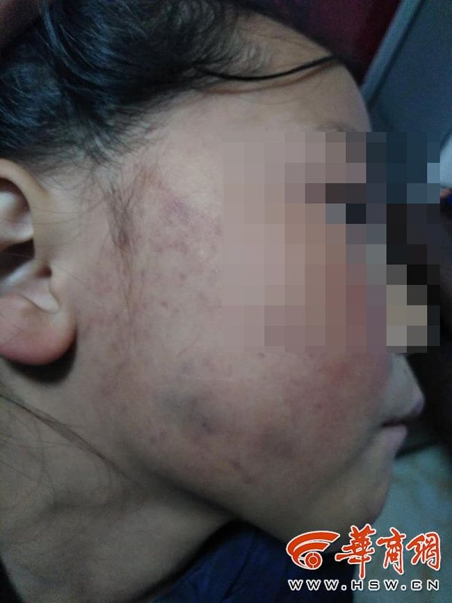 7岁留守女童被老师扇耳光 医院:面部挫伤听力下降