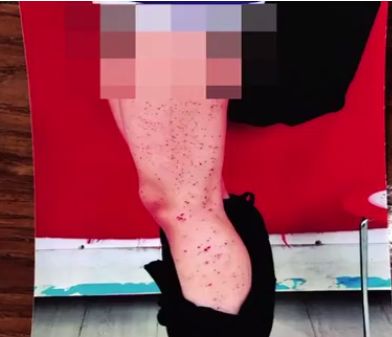 高中女生腿上密密麻麻全是血点 居然是男同桌扎的